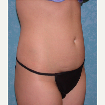 34 year self conscious about fullness in her abdomen before 3731643