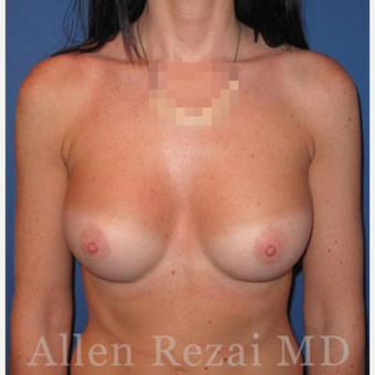 Bilateral Breast Augmentation-Patient has type I Tuberous Breast Deformity - Pre- & 2 Years Post-op after 3473940