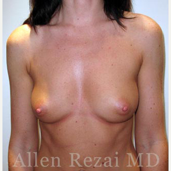 Bilateral Breast Augmentation-Patient has type I Tuberous Breast Deformity - Pre- & 2 Years Post-op before 3473940