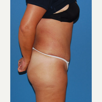 45-54 year old woman treated with Panniculectomy after 3542931