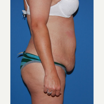 45-54 year old woman treated with Panniculectomy before 3542931