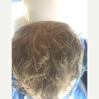 35-44 year old man treated with Hair Loss Treatment after 3109477