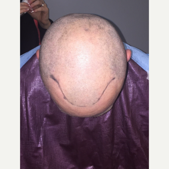 35-44 year old man treated with Hair Loss Treatment before 3109477