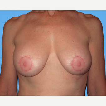 Breast Lift with Implants after 3748671