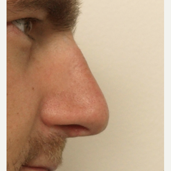 25-34 year old man treated with Rhinoplasty after 3442354