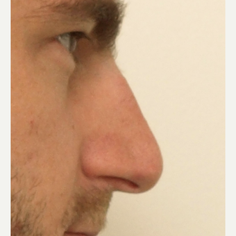 25-34 year old man treated with Rhinoplasty before 3442354