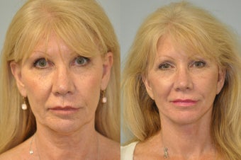 60 year old female underwent facelift, neck lift, upper eyelid surgery and browlift. before 1355700