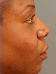 African American Female Rhinoplasty 960131