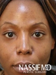 African American Female Rhinoplasty after 960131
