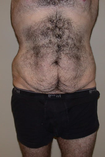 Body Lift before 248632