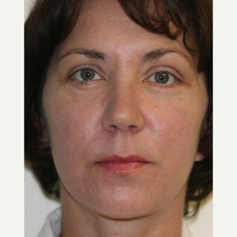 45-54 year old woman treated with Laser Resurfacing after 1554135