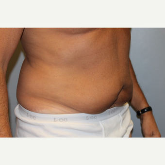 55-64 year old man treated with Tummy Tuck before 3529079
