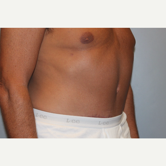 55-64 year old man treated with Tummy Tuck after 3529079