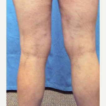 45-54 year old woman treated with Vein Treatment after 3041973
