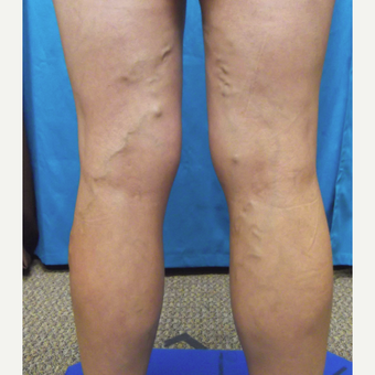 45-54 year old woman treated with Vein Treatment before 3041973