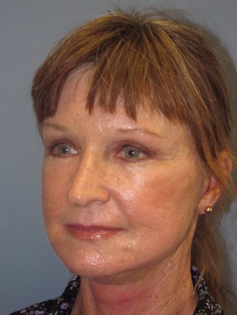 LiteLift on 65-Year-Old Woman 1149645
