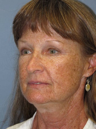 LiteLift on 65-Year-Old Woman 1149645