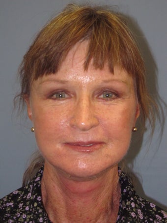 LiteLift on 65-Year-Old Woman after 1149645