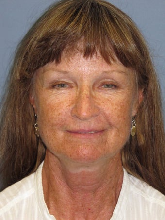 LiteLift on 65-Year-Old Woman before 1149645
