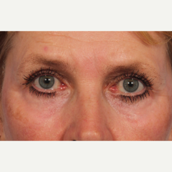 45-54 year old woman treated with Laser Resurfacing after 3657778
