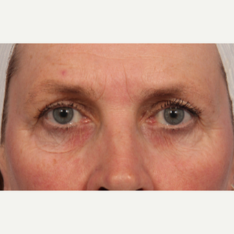45-54 year old woman treated with Laser Resurfacing before 3657778