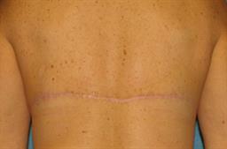 Back Lift Creates Smooth Lines Under Clothing after 1323546