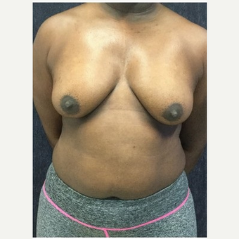 35-44 year old woman treated with Breast Lift with Implants before 3219398
