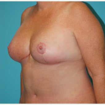 45-54 year old woman treated with Breast Reduction after 2615685