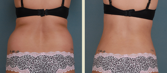 Liposuction 1378049