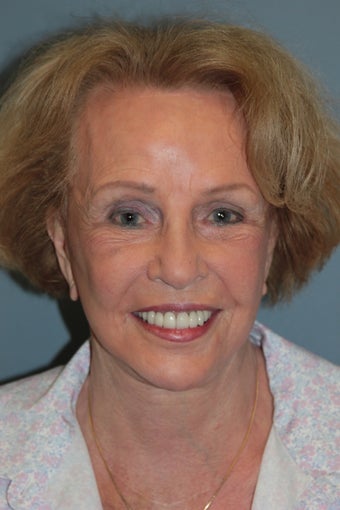 LiteLift™ on 82-year-old Woman after 1075746