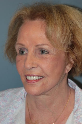 LiteLift™ on 82-year-old Woman 1075746