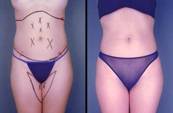 Tumescent Liposuction before 996375