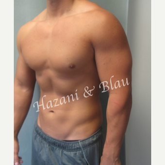 18-24 year old man treated with Male Breast Reduction after 3332915