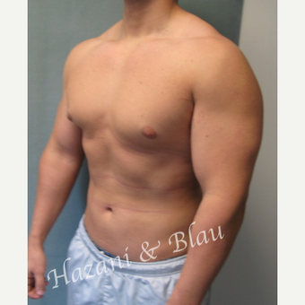 18-24 year old man treated with Male Breast Reduction before 3332915