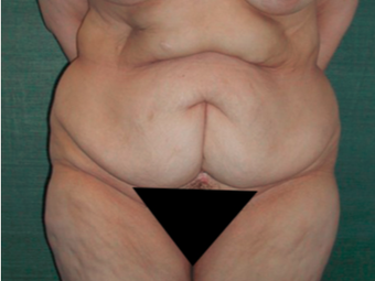 45-54 year old woman treated with Tummy Tuck before 3417816