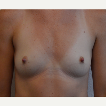 25-34 year old woman treated with Breast Augmentation before 3581553