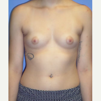 18-24 year old woman treated with Breast Implants before 3370267