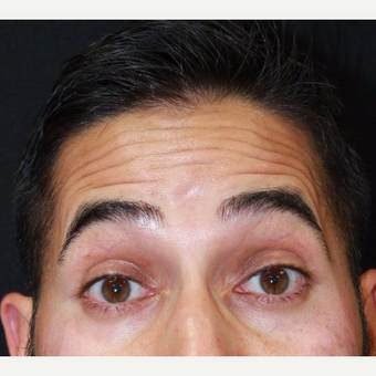 37 year old male treated with Botox for forehead lines before 3128880