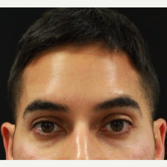 37 year old male treated with Botox for forehead lines after 3128880