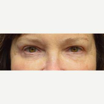 65-74 year old woman treated with Eyelid Surgery after 3162151