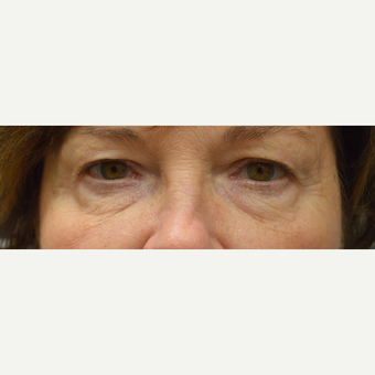 65-74 year old woman treated with Eyelid Surgery before 3162151