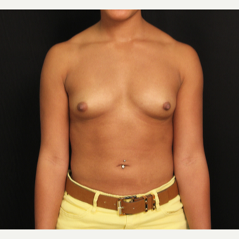 26 year old female with bilateral submuscular silicone implants placed through the underarm before 3522685