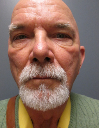 65-74 year old man treated with Eye Bags Treatment before 2206790