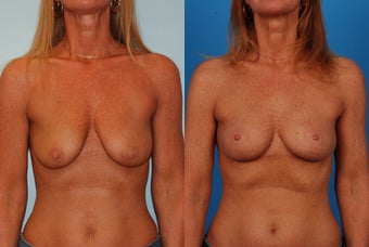 Breast Lift: 45-Year-Old Woman before 1049647