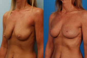 Breast Lift: 45-Year-Old Woman after 1049647