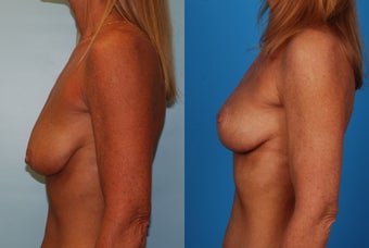 Breast Lift: 45-Year-Old Woman 1049647
