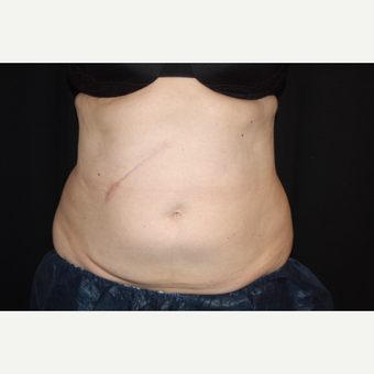 55-64 year old woman treated with CoolSculpting after 3366329