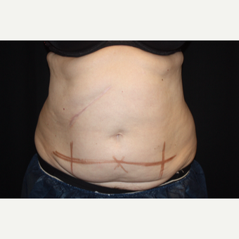 55-64 year old woman treated with CoolSculpting before 3366329