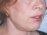 Adult Cleft Patient Receiving Face Lift with Cheek Implants after 1279713