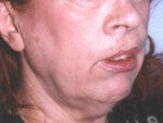 Adult Cleft Patient Receiving Face Lift with Cheek Implants before 1279713